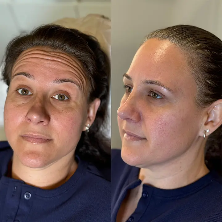 AnyConv.com__botox